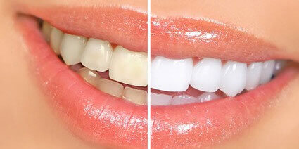 blanqueamiento-dental-mallorca