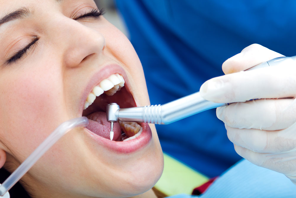 limpieza-dental-profesional-2